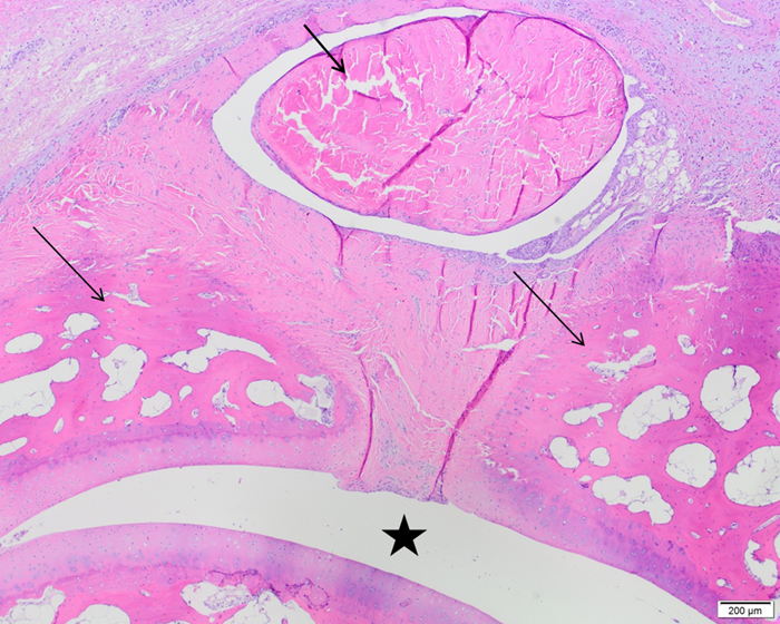 distale falanx