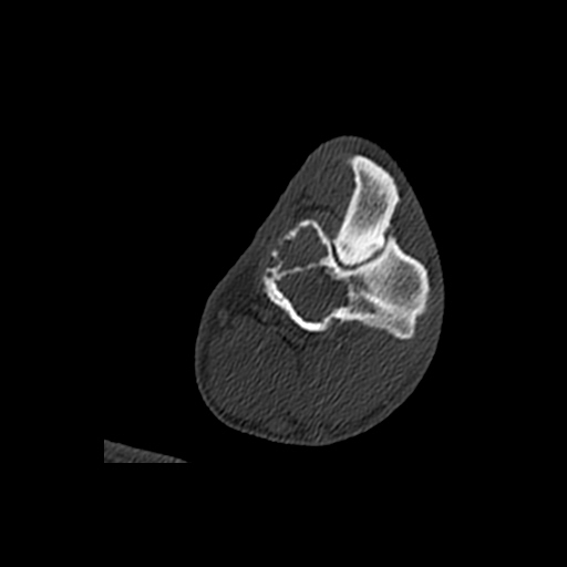 Multipele maligne tumor