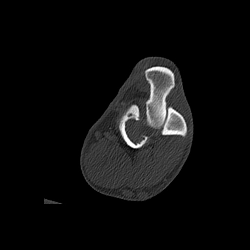 Multipele maligne tumor